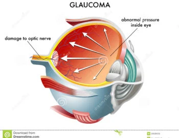 Glaucoom