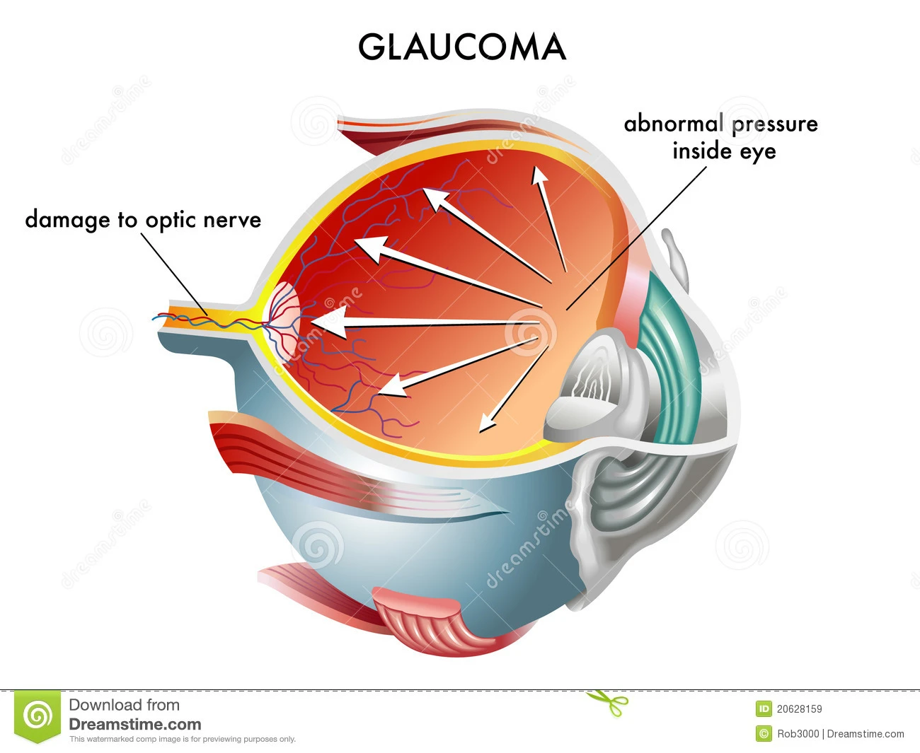 Glaucoom