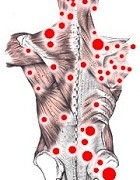Fibromyalgie