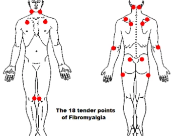 Fibromyalgie