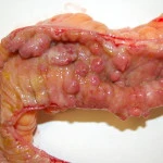 Colitus Ulcerosa en Ziekte van Crohn
