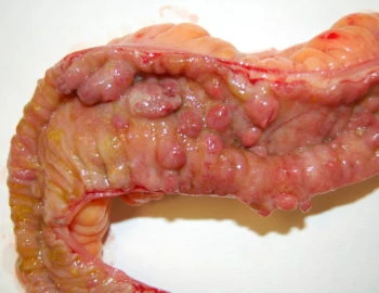 Colitus Ulcerosa en Ziekte van Crohn