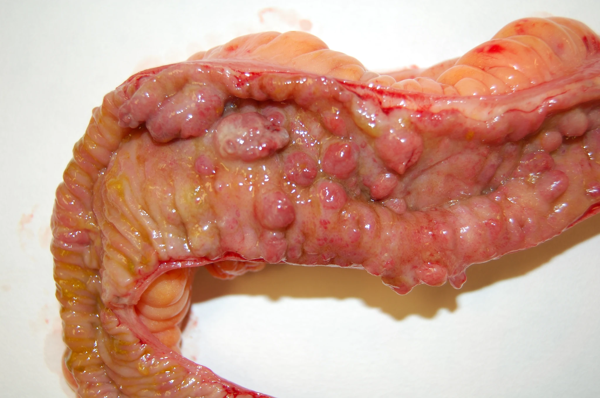 Colitus Ulcerosa en Ziekte van Crohn