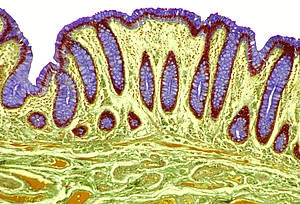 Holistische behandeling Colitus Ulcerosa en Ziekte van Crohn